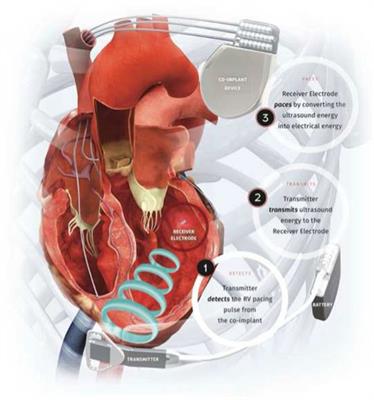 Pacing interventions in non-responders to cardiac resynchronization therapy